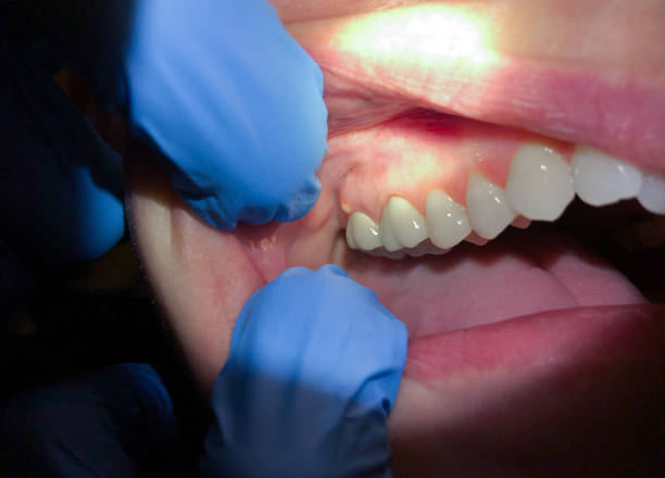 Best Emergency Dental Care for Sports Injuries in Fruitdale, CA